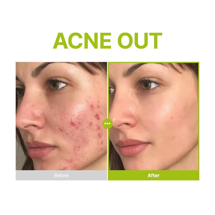 Purito Azelaic Acid 10 Kojic Tea Tree Serum