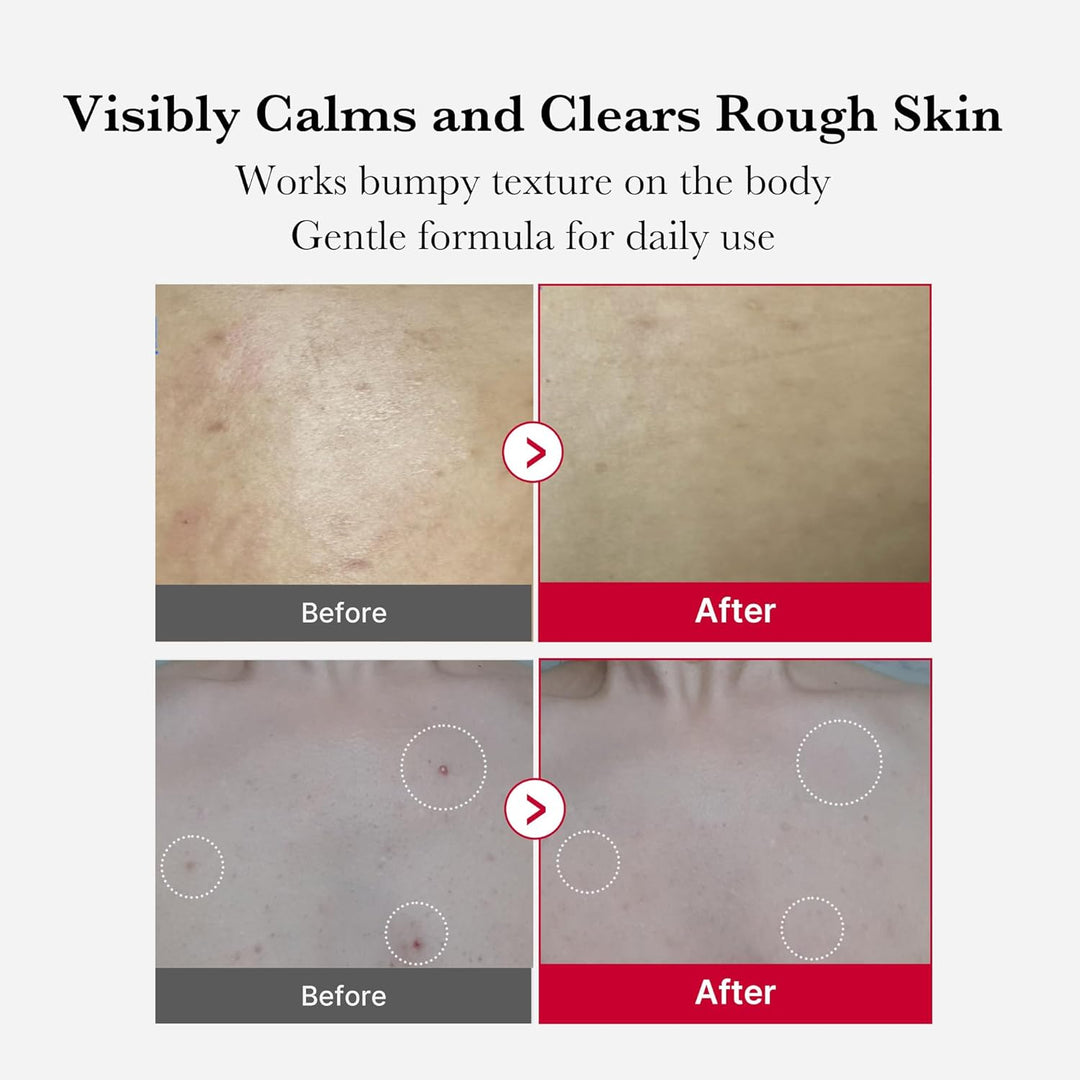 Medicube - Red Acne Body Peeling Shot