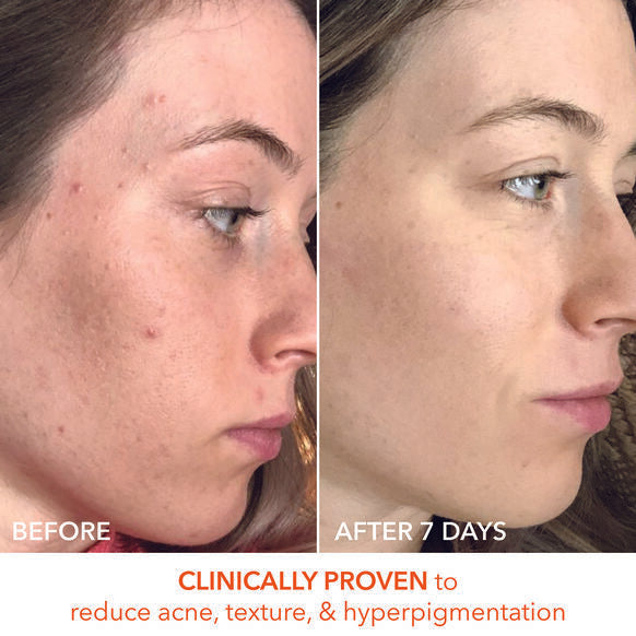 Dr. Dennis Gross – Alpha Beta® Universal Daily Peel